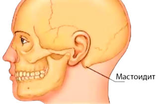 Gonflement Douloureux Sous L Oreille D Un Enfant Pourquoi Il Y Avait Une Bosse Derriere L Oreille Et Comment Le Traiter